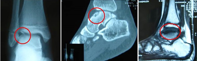 X-ray, CT, MRI σχαλιδωτική οστεοχονδρίτιδα αστραγάλου